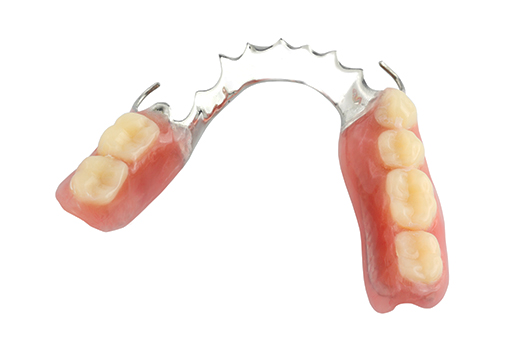 Prothèse dentaire partielle amovible | Tourigny & Thibault Denturologistes