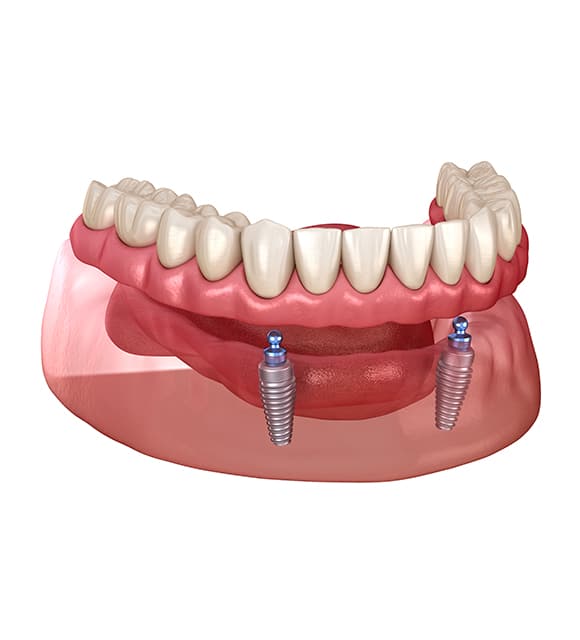 tourigny thibault denturologistes implant 3