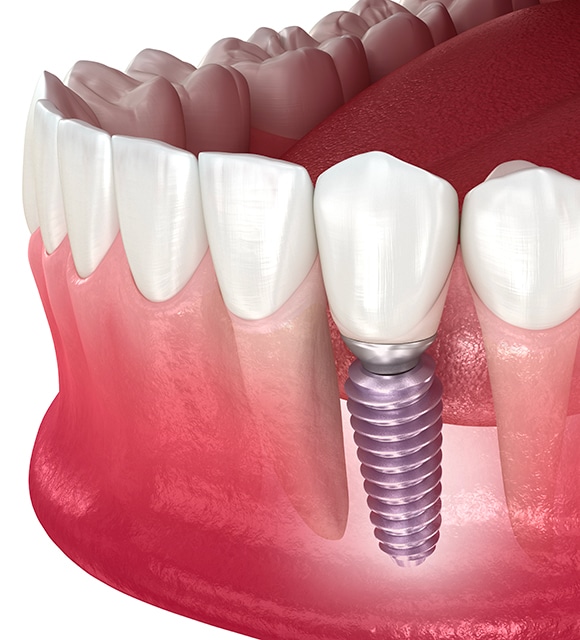 tourigny thibault denturologistes implant 4